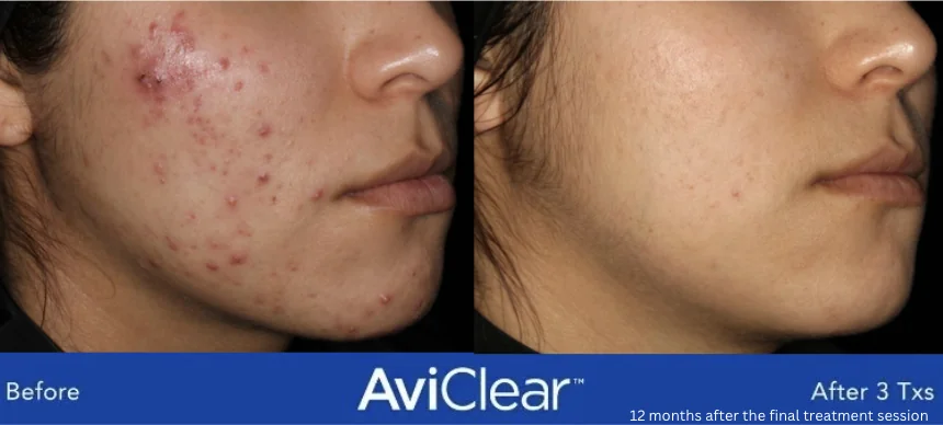Before and After of Avi Clear Acne Treatments